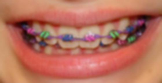 "จัดฟันแฟชั่น" สวยหลอกๆ แต่อันตรายจริงๆ