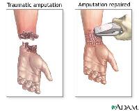 amputation การ พยาบาล เปาโล