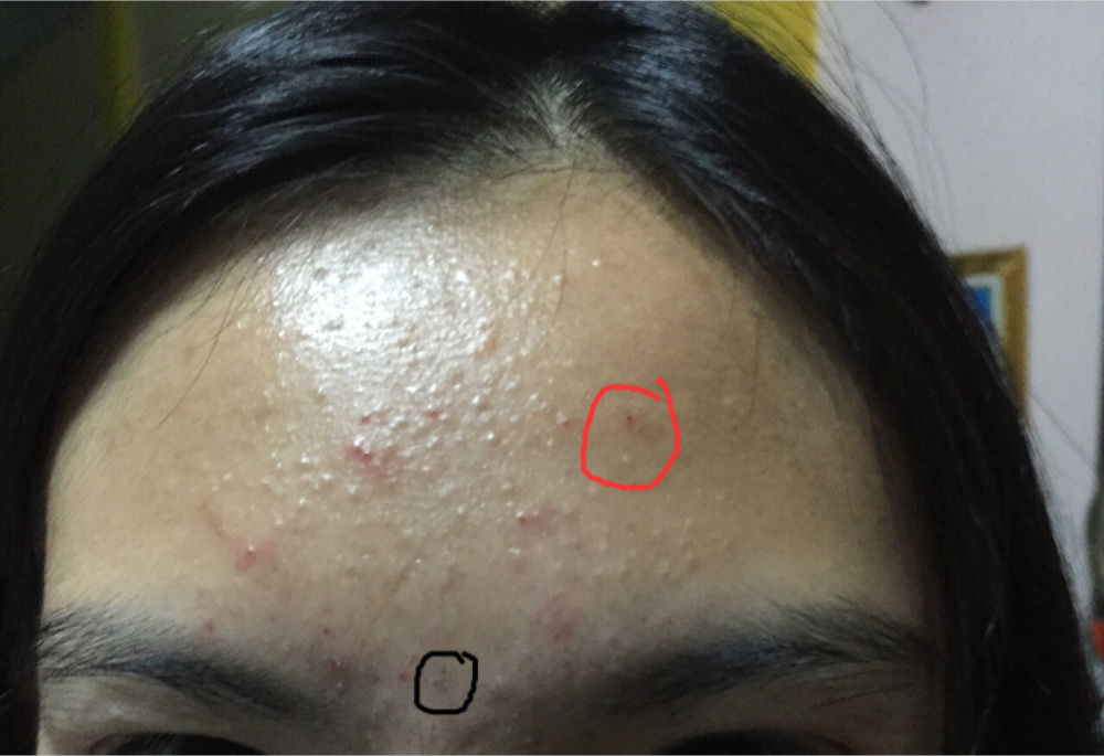 ร ป หน าแบบน ส วอะไรน แนะนำการร กษาหน าท ค ะ Dek D Com