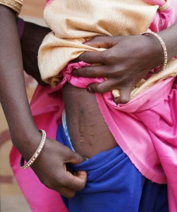 แผลเป็นจากเหมืองถล่มของ Surma Kumari วัย 11 ขวบ