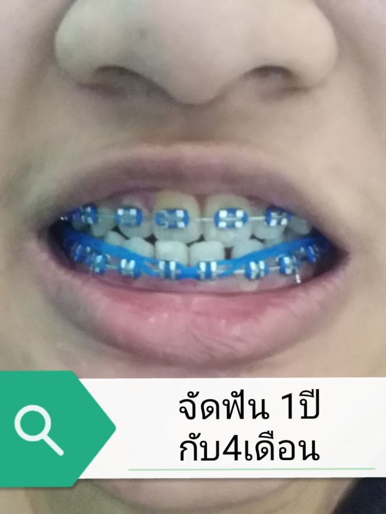 รีวิวจัดฟันแบบจัดเต็ม!?(1) | Dek-D.Com