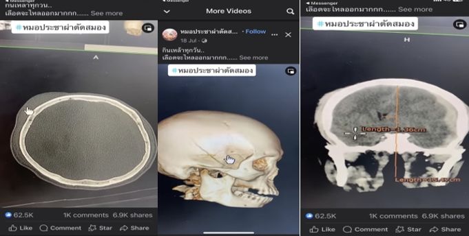 ภาพจากซ้ายไปขวา ภาพสแกนศีรษะมีอาการบวม , ภาพสแกนกะโหลกร้าวจากแรงกระแทก , ภาพสแกนสมองเคลื่อนจากตำแหน่ง 1.36 เซนติเมตร